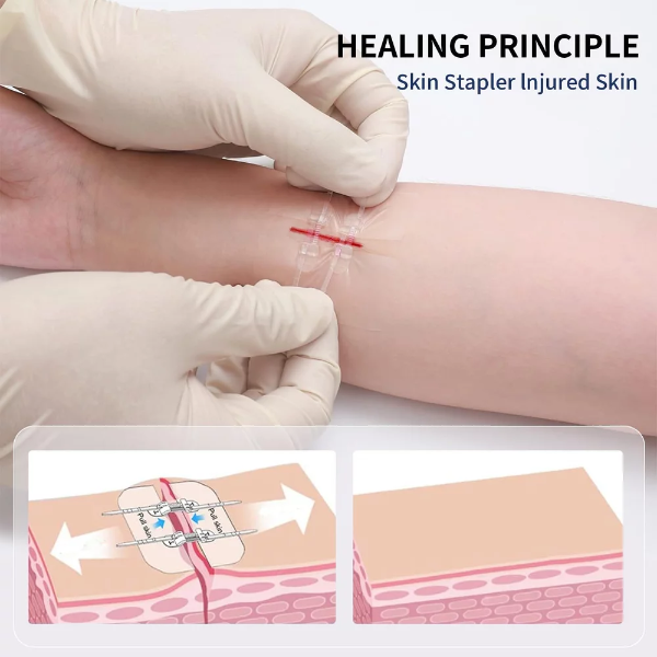 2 Pcs Bandages For Wounds, Zip Stitch For Skin, Zip Close Bandage For Emergency Wound Care, Zip Stitch Sutures, Extra Large Band Aid, Waterproof Butterfly Strips Wound Closure - Image 3