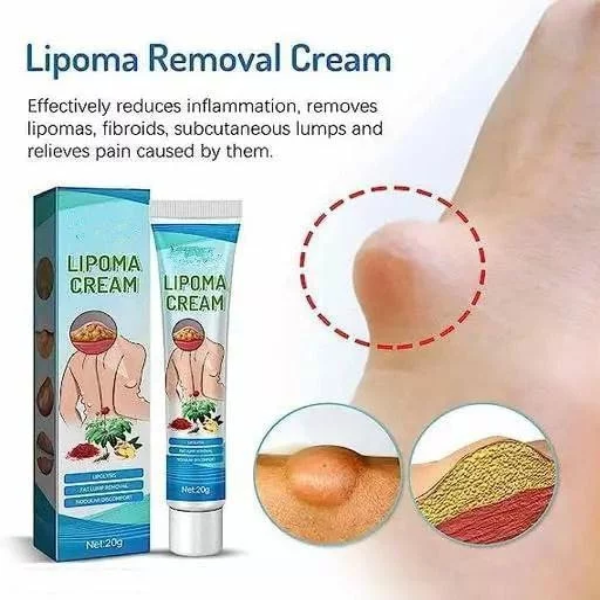 30gLipoma Removal Cream, Lipoma Removal Cream Ointment, Lipoma Elimination Cream, for Lipoma Treatment Cellulite Removal Cream, Anti-Swelling Lymphatic Detox Ointment (Pack of 3) - Image 3