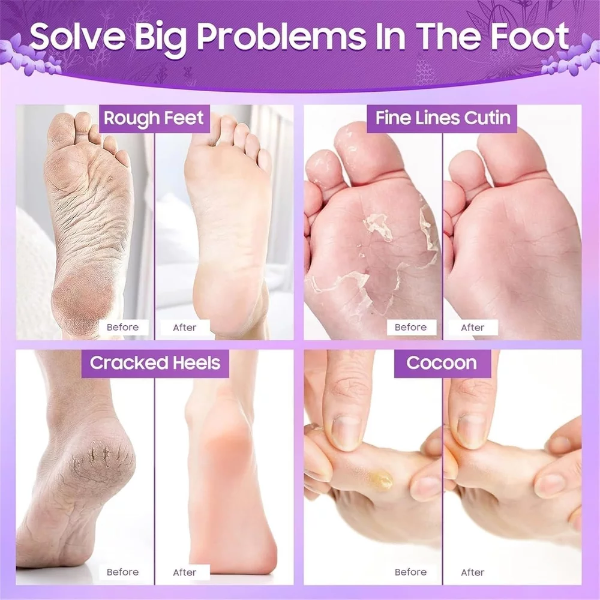 Abhaymart Lavender Peeling Foot Mask for Cracked Heels – Dead Skin Remover & Exfoliating Foot Peel for Soft Smooth Feet | At-Home Pedicure Foot Care with Moisturizing Formula - Image 3