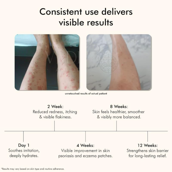 VEDICDERM Natural Psoriasis Cream for Dry Itchy Skin Steroid-Free Formula with Ayurvedic Herbs Helps Soothe Redness, Flakiness & Irritation Moisturizing Body Cream for Sensitive Skin (200ml Pack of 2) - Image 2